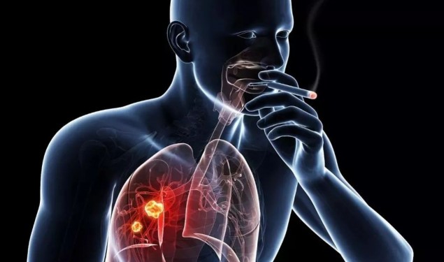 肺癌（上篇）：烟害不是唯一兇手