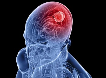 【医疗专题】偏头痛（上篇）：头痛，是一种病